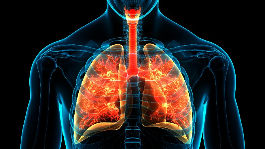 La surproduction de mucus a été liée à une inflammation pulmonaire typique du COVID-19 sévère (The Lundquist Institute)