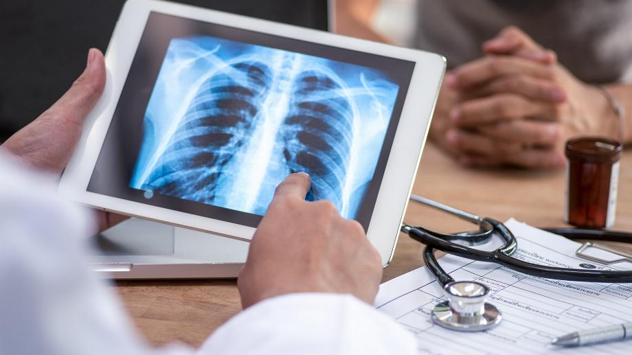 Les lésions pulmonaires ont augmenté jusqu'à 1 an après avoir souffert de COVID-19