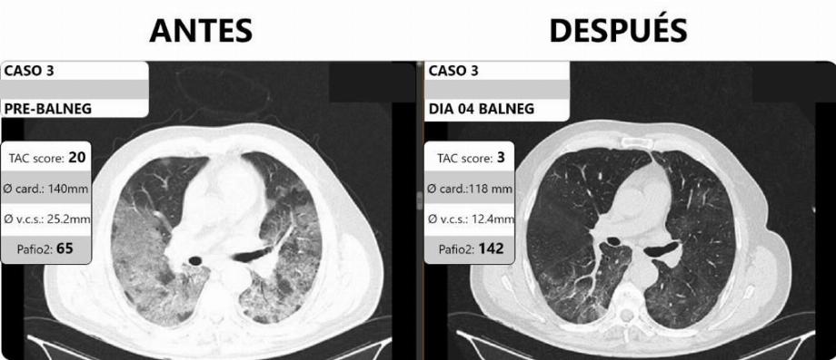 L'image prise par le Dr Santos est éloquente : des chercheurs de Mar del Plata ont découvert que le traitement aux diurétiques offrait une option efficace pour réduire la rétention d'eau dans les poumons, rétablir l'oxygénation et réduire la mortalité des patients.