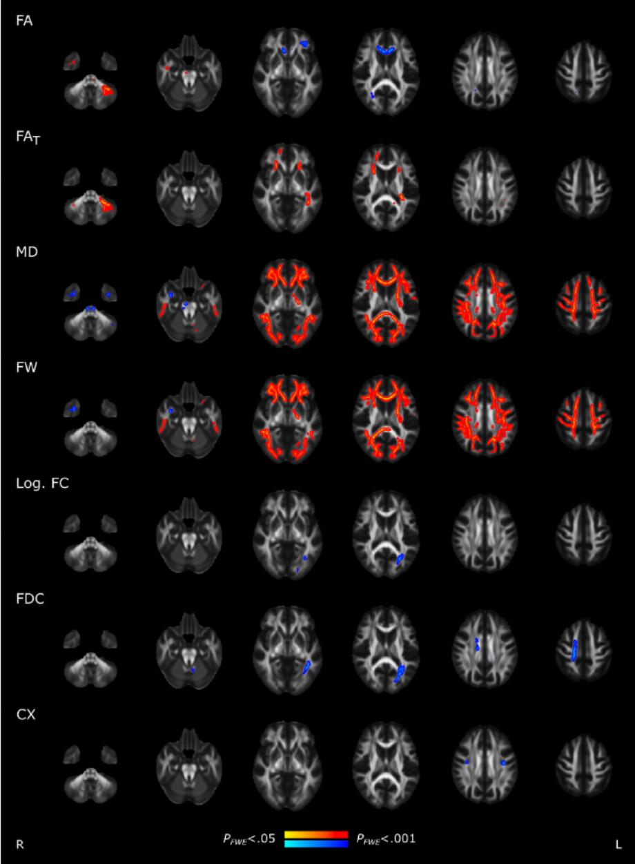 Les 2 résultats de l'IRM, la diffusivité moyenne et l'eau libre, tous deux indicatifs d'une inflammation cérébrale, surlignés en rouge, ont montré des différences significatives entre les individus atteints de COVID et les témoins
