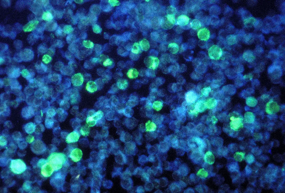 Photomicrographie de cellules leucémiques contenant le virus Epstein-Barr (EBV), l'un des virus les plus courants chez l'homme (Smith Collection/Gado/Getty Images).