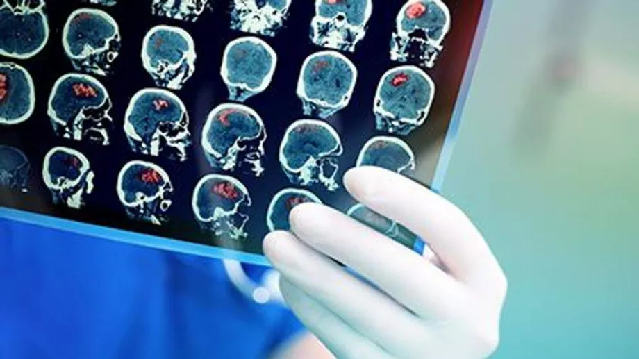 Les personnes atteintes d’un long COVID peuvent présenter des modifications cérébrales responsables de leurs symptômes prolongés